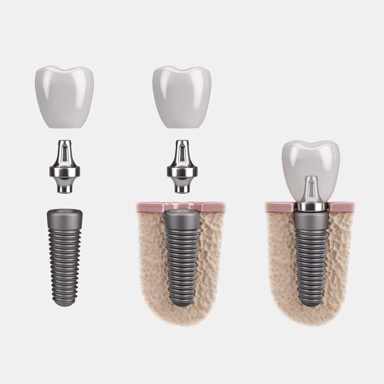 Dental Implants Seattle