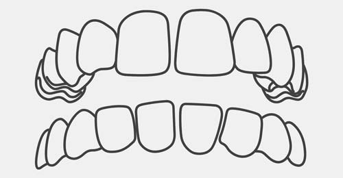 Crooked Teeth Level 1