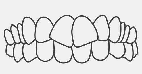 Crooked Teeth Level 2